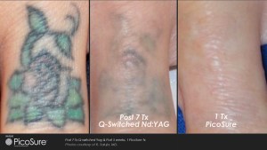 Tattoo removal before and afters