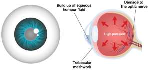 What is Glaucoma Graphic